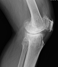 変形性膝関節症 側面