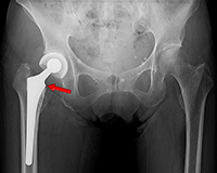 人工骨頭置換術:図2